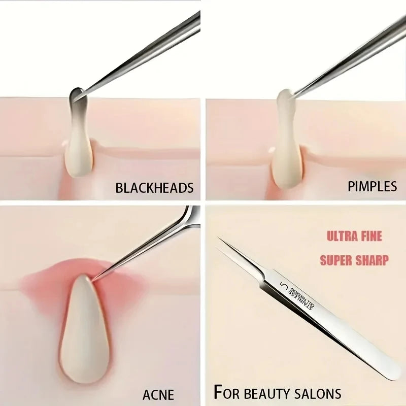 Easy-To-Use Stainless Steel Acne Extractor Set - Hypoallergenic Beauty Tweezers For Clear Skin, Perfect For Beginners
