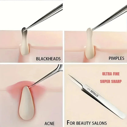Easy-To-Use Stainless Steel Acne Extractor Set - Hypoallergenic Beauty Tweezers For Clear Skin, Perfect For Beginners