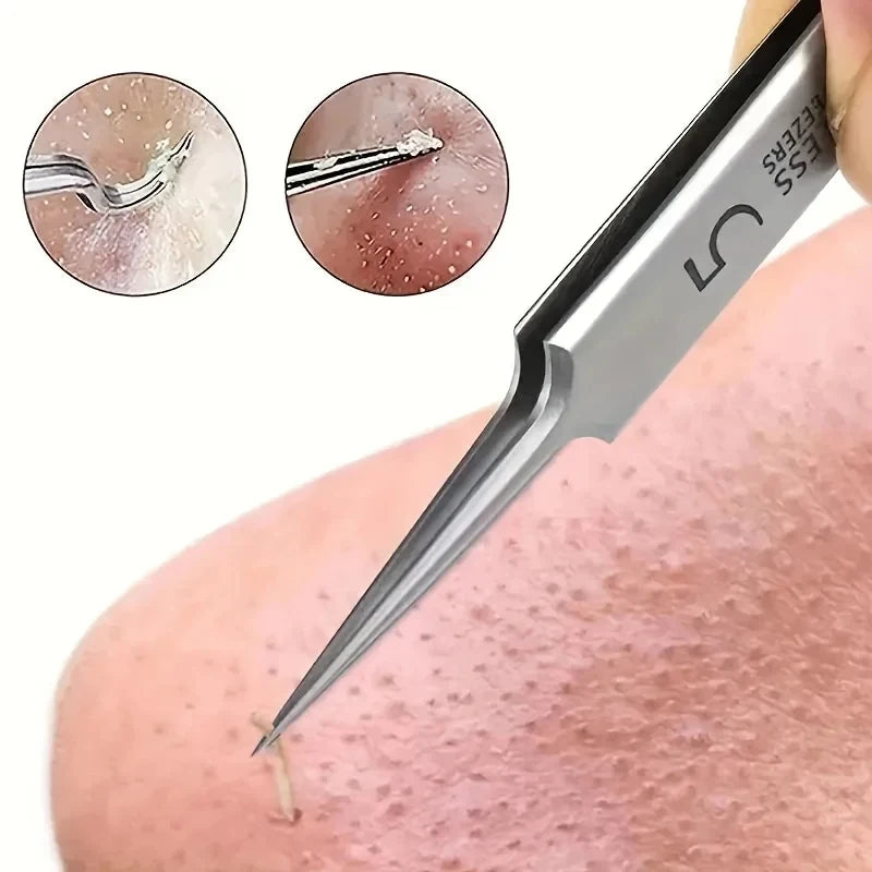 Easy-To-Use Stainless Steel Acne Extractor Set - Hypoallergenic Beauty Tweezers For Clear Skin, Perfect For Beginners